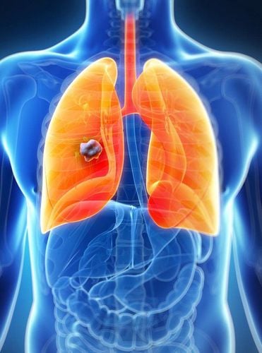 Computed tomography scan for suspected lung tumor