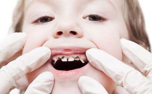 Harm of children's tooth decay