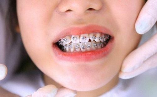 "Golden" time for braces for children