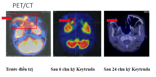 Tế bào học chọc hút bằng kim nhỏ (fna) - Các bệnh lý hạch lympho