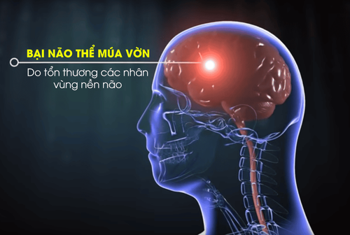 Diagnosis of cerebral palsy