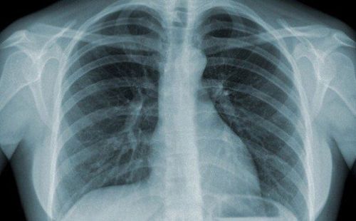 Người dị ứng kháng sinh có thể dùng thuốc cản quang chụp CT phổi không?