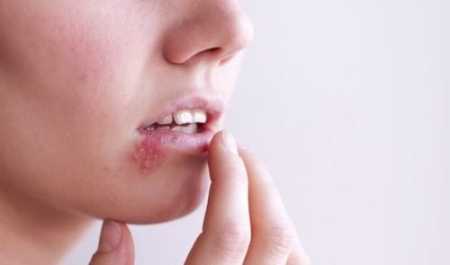 
Vết loét xung quanh miệng do virus herpes gây ra
