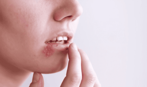 Herpes (cold sores) on the lips: What you need to know