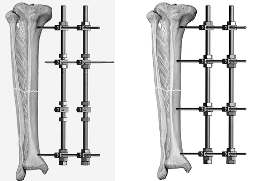 Các biến chứng sau mổ kết hợp xương có thể gặp