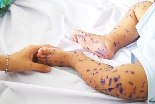 Chickenpox: When is the right time to apply methylene blue?