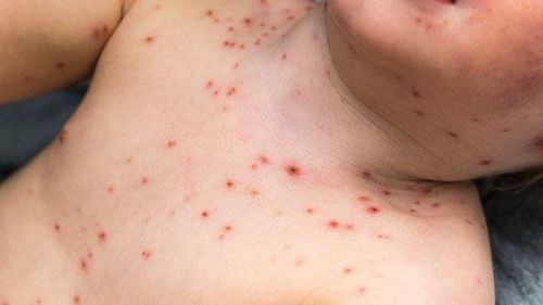 Is chickenpox scabs still contagious?