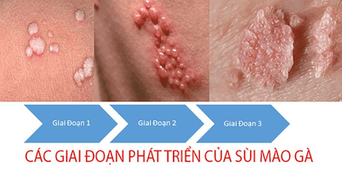 
Mụn cóc sinh dục ở nam giới thường do virus HPV
