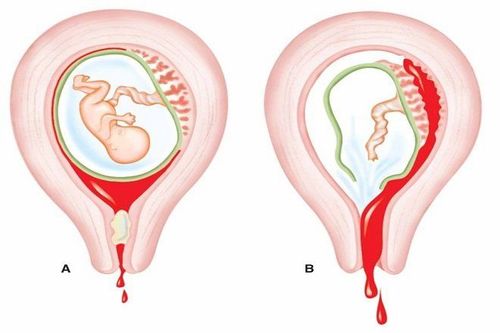 
Nguyên nhân gây bế sản dịch sau sinh là do còn sót nhau thai
