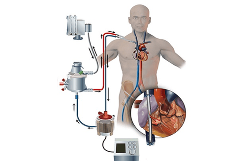 What is ECMO (cardiopulmonary bypass)?