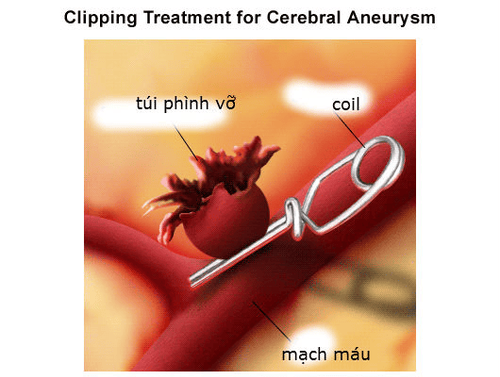 
Phình mạch máu não là một bệnh lý nguy hiểm, nguy cơ để lại di chứng cao thậm chí là tử vong
