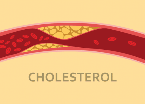 
Cholesterol trong cơ thể quá cao dẫn đến xơ vữa động mạch
