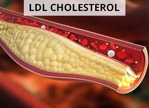 
LDL là cholesterol xấu
