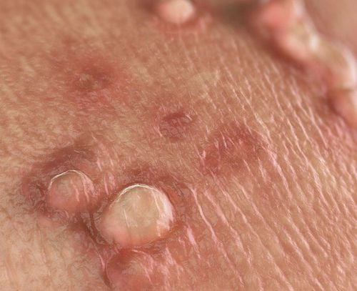 What is the difference between genital warts and genital herpes?