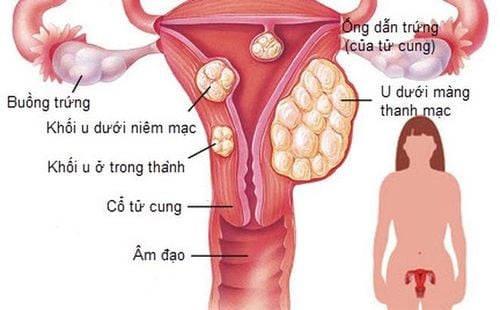 
U xơ tử cung là những khối u nhỏ lành tính phát triển và thành hình trong cơ tử cung
