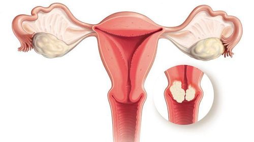 Uterine fibroids are often discovered incidentally, with few obvious symptoms