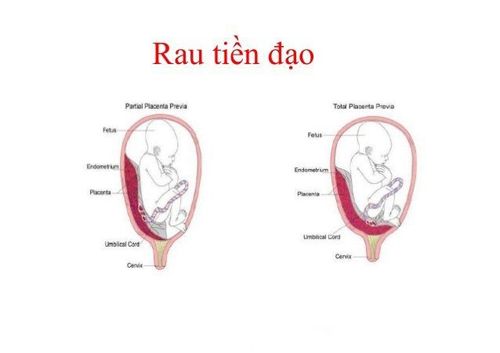 
Hình ảnh rau tiền đạo trong thai kỳ.
