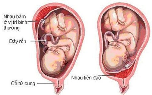 Complications of placenta previa in pregnant women