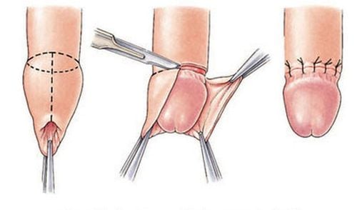 How is circumcision surgery performed?