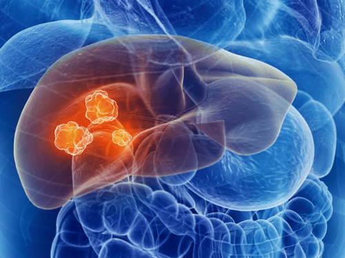 Metastatic liver cancer: What you need to know