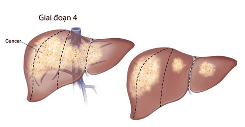 
Ở giai đoạn 4 ung thư gan có dấu hiệu di căn tới các cơ quan khác trên cơ thể
