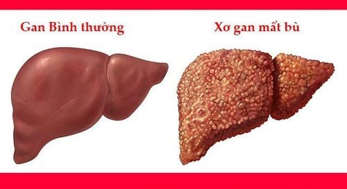 
Hình ảnh xơ gan mất bù
