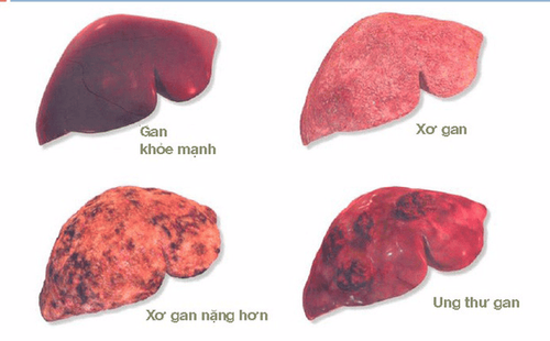 
Xơ gan dẫn tới ung thư gan
