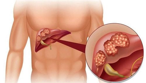 Leg edema and abdominal distension in liver cancer: What you need to know