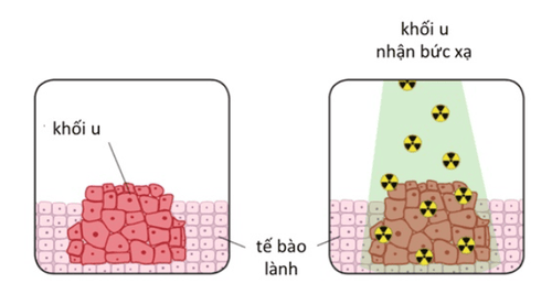 Xạ trị là phương pháp điều trị ung thư sử dụng chùm tia năng lượng cao (như tia X, tia gamma) để tiêu diệt tế bào ung thư và kìm hãm sự phát triển của khối u. 