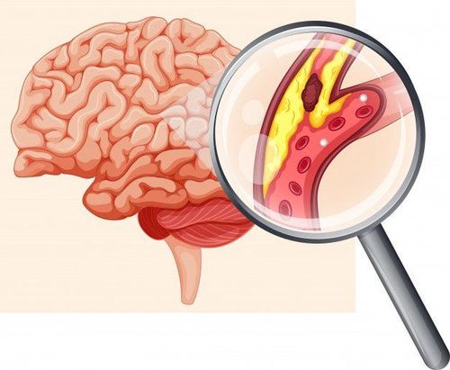 Blood clot formation in cerebrovascular accident