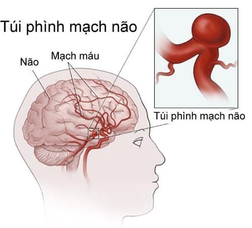 
Hình ảnh túi phình mạch não
