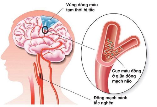 
Cục máu đông trong tai biến mạch máu não
