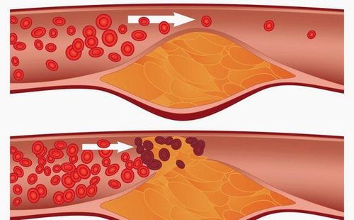 
Các yếu tố làm tăng nguy cơ xảy ra tai biến mạch máu não: tăng huyết áp, đái tháo đường, bệnh tim mạch
