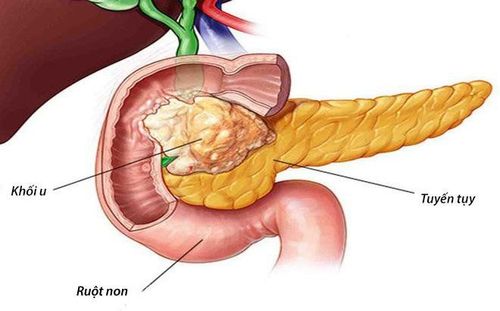 Complications of biliary compression of pancreatic head tumors