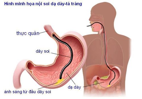 Nội soi đường tiêu hóa trên: Những điều cần biết