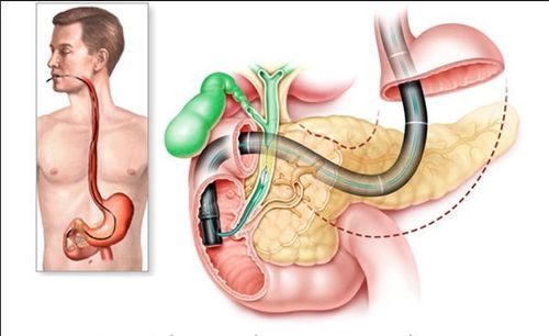 
Dùng nội soi tá tràng cắt cơ Oddi để lấy sỏi ống mật chủ
