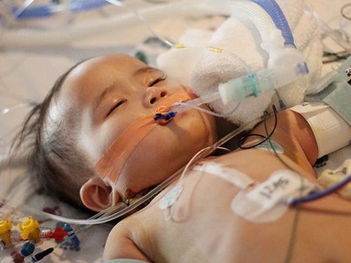 Anesthesia for intubation in young children