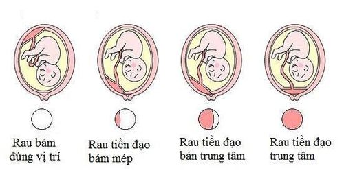 
Căn cứ vào vị trí rau bám thì có 4 loại rau tiền đạo thường gặp
