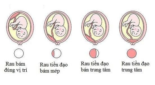 
Rau tiền đạo làm cản trở đường ra của thai nhi
