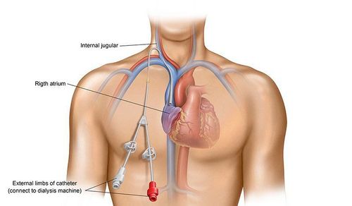 Advantages of central venous catheterization under ultrasound guidance