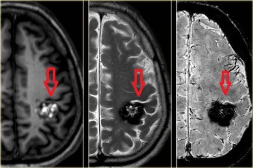 Diagnosis of cerebral palsy by magnetic resonance imaging technique