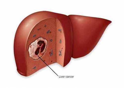 
Một vài bệnh ung thư có thể bắt đầu ở gan
