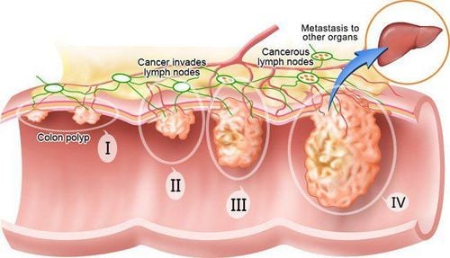 Các giai đoạn ung thư: 5 lý do quan trọng bạn cần biết