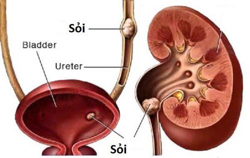 
Sỏi đường niệu có thể gây nhiều biến chứng nguy hiểm
