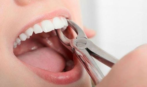 Chảy máu sau nhổ răng: Những điều cần biết