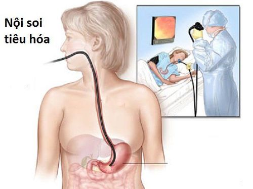 Vì sao nội soi tiêu hóa có vai trò lớn trong sàng lọc sớm ung thư tiêu hóa?