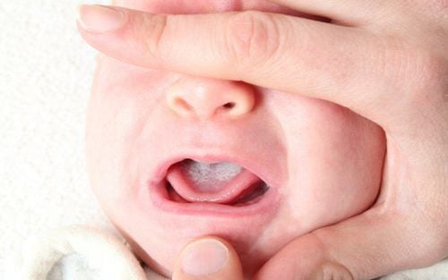 Lưỡi của trẻ xuất hiện từng đốm đỏ cách chữa tại nhà như thế nào?