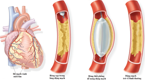 Myocardial infarction: When to use thrombolytic drugs, when to intervene?