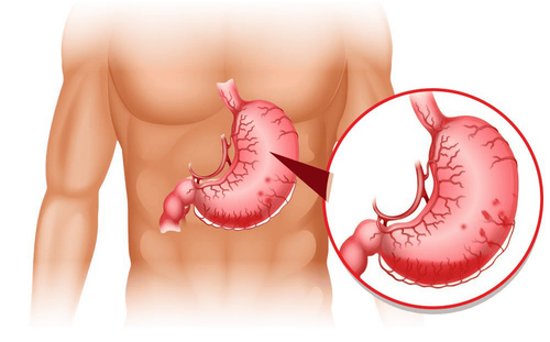 What is gastric prolapse?