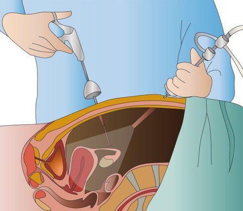 Anesthesia in laparoscopy